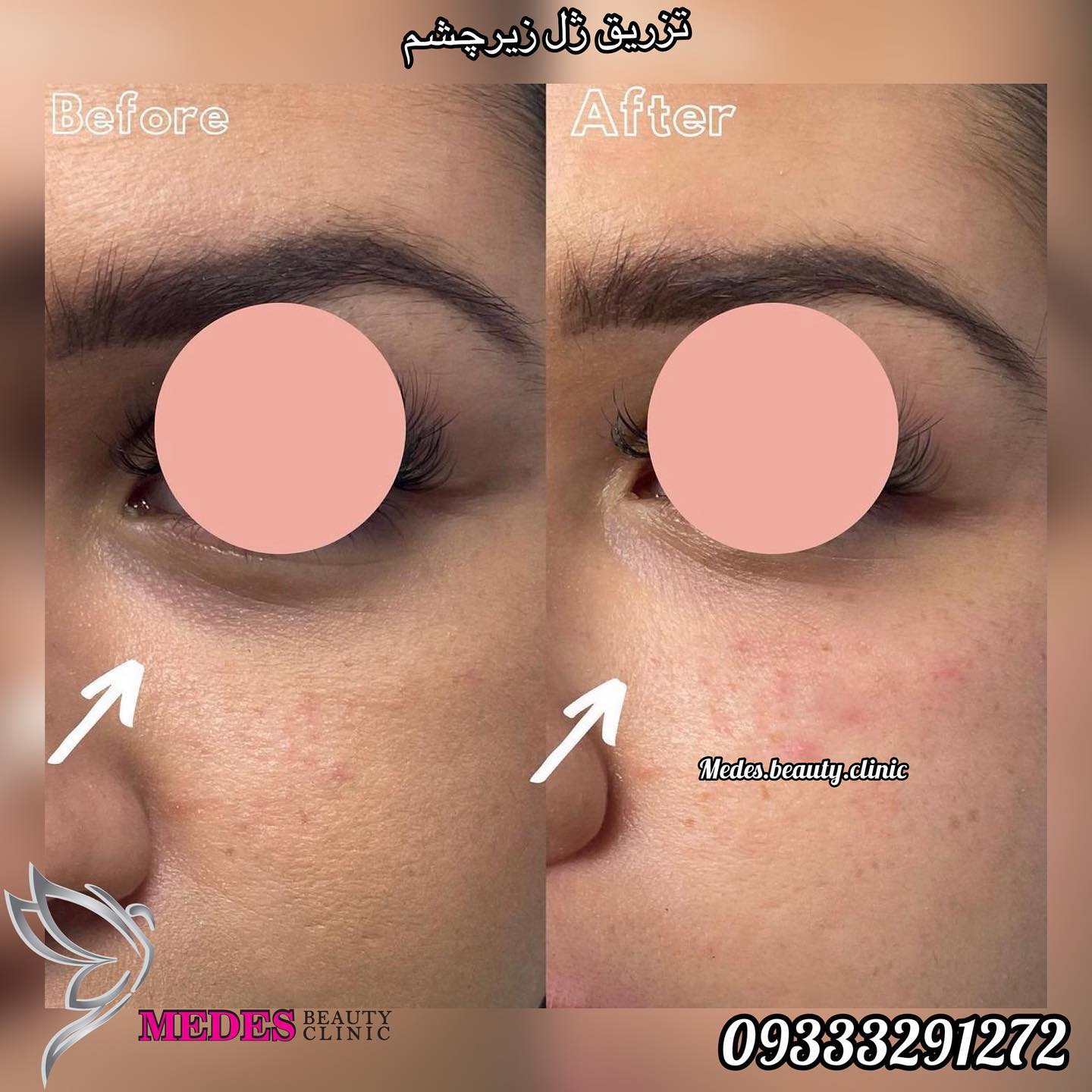 گالری فیلر زیر چشم